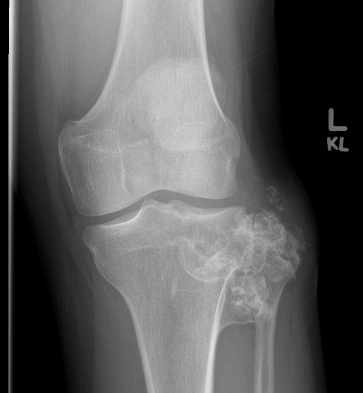 Chondrosarcoma from Osteochondroma